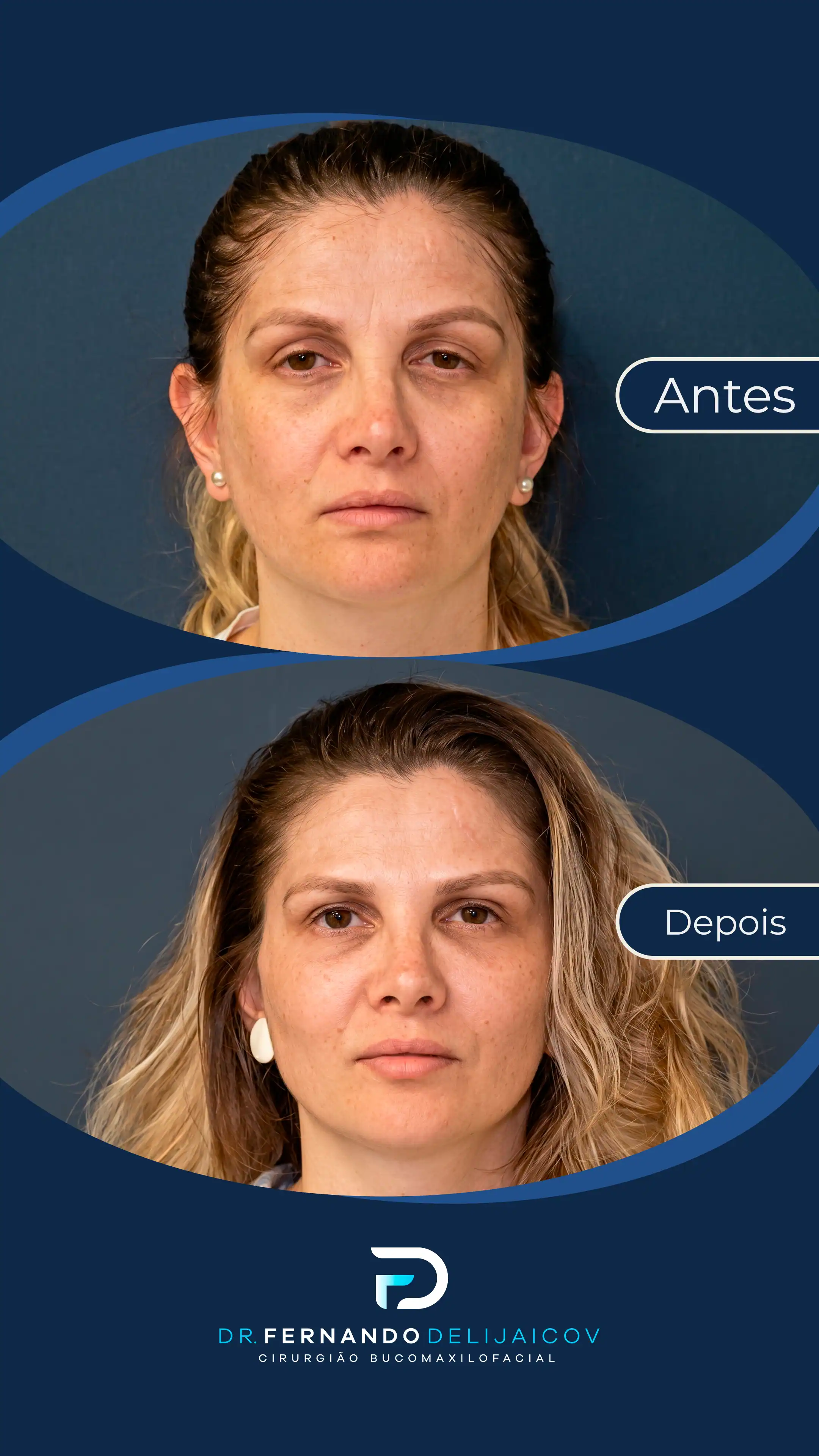 Resultado antes e depois 1